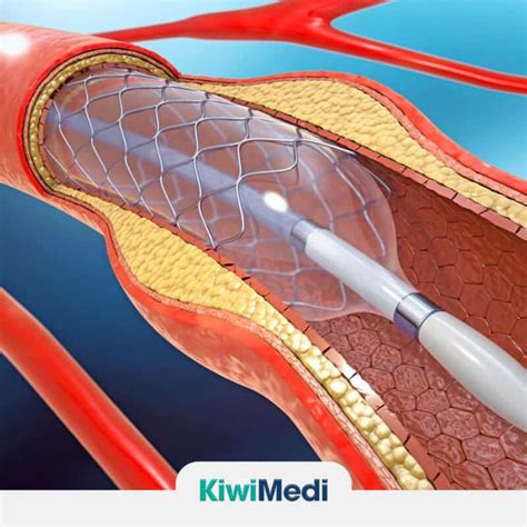 Risks And Complications Of Angioplasty Stenting Procedure
