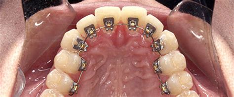 What Are Lingual Braces Affordable Braces Jorgensen Orthodontics