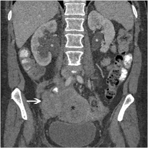 Locally Invasive Cervical Carcinoma Coronal Contrast Enhanced Ct Shows