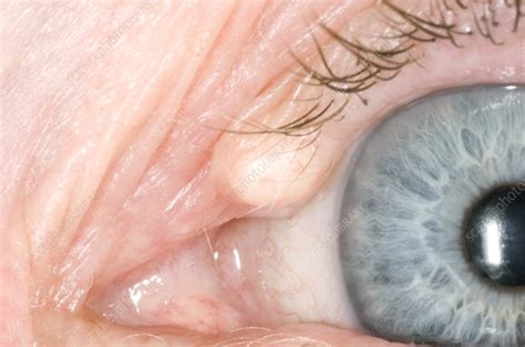 Eye Cyst Stock Image C0016964 Science Photo Library