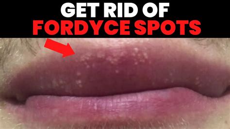 What Do Fordyce Spots Look Like On Lips Sitelip Org