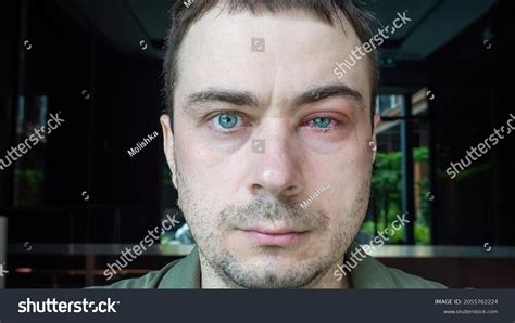 Portrait Man Swollen Eye Suffers Conjunctivitis Stock Photo 2055762224