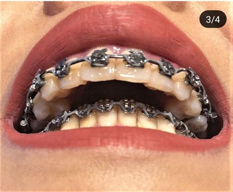 Pin By John Beeson On Orthodontic Braces Orthodontics Braces Braces Colors Orthodontics