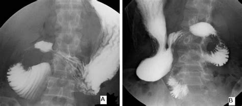 A Causal Relationship Between Right Paraduodenal Hernia And Superior