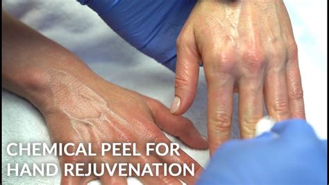 Tca Phenol Chemical Peel For Hand Wrinkle And Sun Damage Rejuvenation