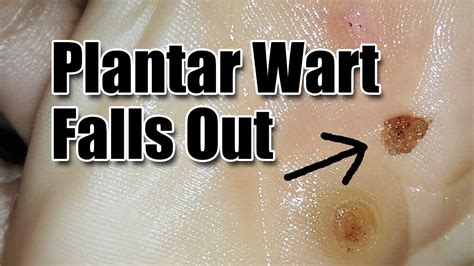 How To Get Rid Of Plantar Warts On Foot Get Rid Of Verruca Youtube