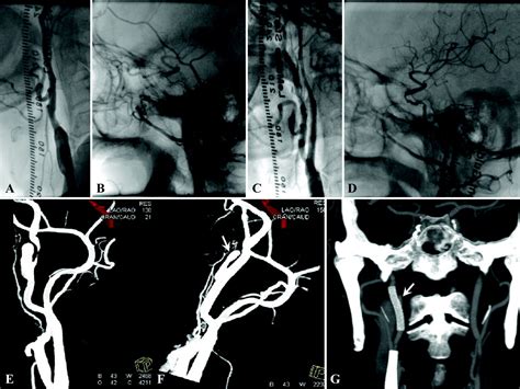 Procedural Safety And Potential Vascular Complication Of Endovascular