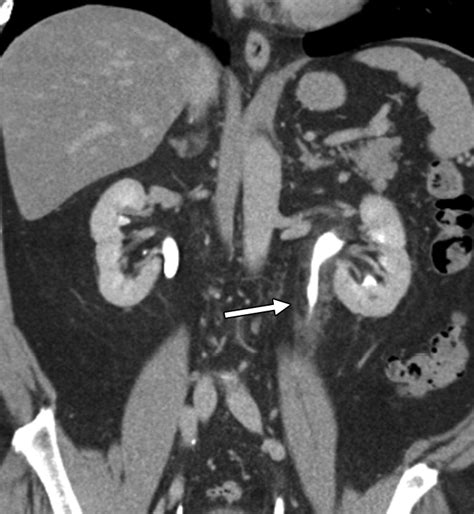 Mdct Evaluation Of Ureteral Tumors Advantages Of 3d Reconstruction And