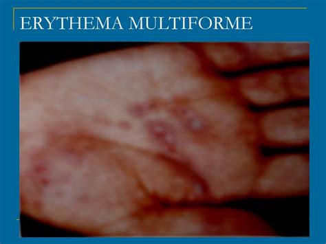 Ppt Erythema Multiforme And Stevens Johnson Syndrome Sjs Toxic