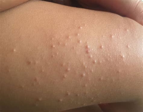 Viral Infections Children Adult Skin