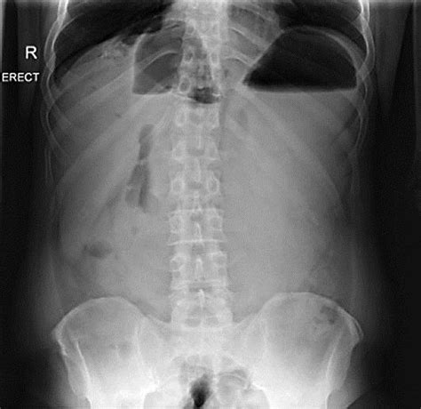 Abdominal X Ray Showing Airfluid Level Dilated Stomach And