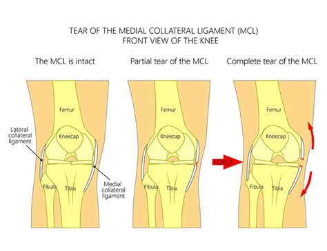 Sports Injury Treatment In Kerala Ligament Tear Treatment India