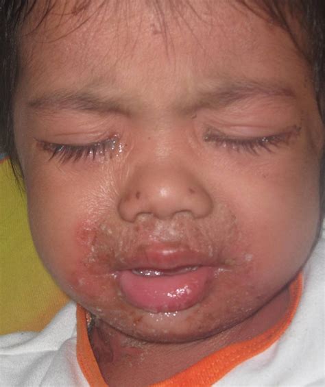Staph Scalded Skin Syndrome Pictures Photos