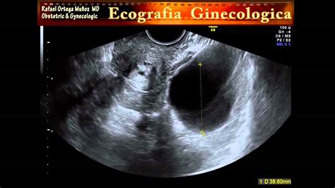Ecografia 2d 3d Y 4d Utero Y Quiste Folicular Clinica Ginecologica Dr