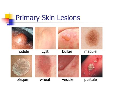 Primary Skin Lesions 피부