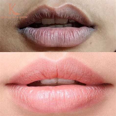 Dark Lip Treatment