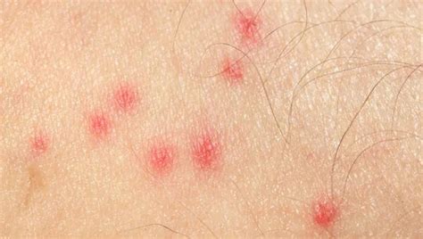 Best Allergy Medicine For Mosquito Bites Medicinewalls