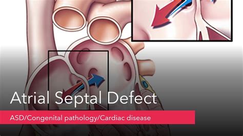 Atrial Septal Defectasdtypes Of Asdcardiovascular Perfusionist Youtube