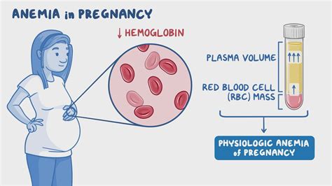 Anemia In Pregnancy Clinical Sciences Osmosis Video Library