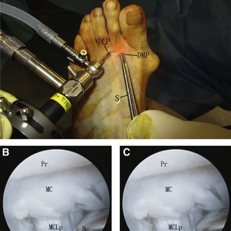Correction Of Crossover Toe Deformity Of Left Second Toe By Plantar Download Scientific Diagram