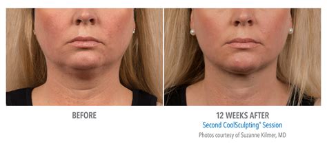 Coolsculpting To Remove Double Chin Fat Reduction Beverly Hills Los