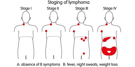 Childhood Hodgkin Lymphoma Disease Stages And Prognosis Acco