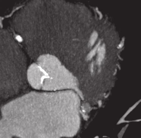 Calcification Of Aortic Valve Leaflets Shown In Multi Slice Computed