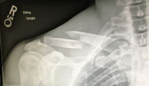 The patients who had undergone nailing showed significantly. Clavicle Plate Removal: CollarBone Surgical Repair ...