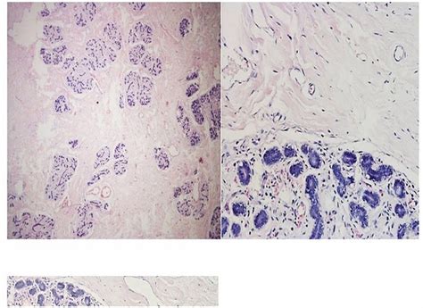 Largest Giant Juvenile Fibroadenoma Of The Breast Bmj Case Reports