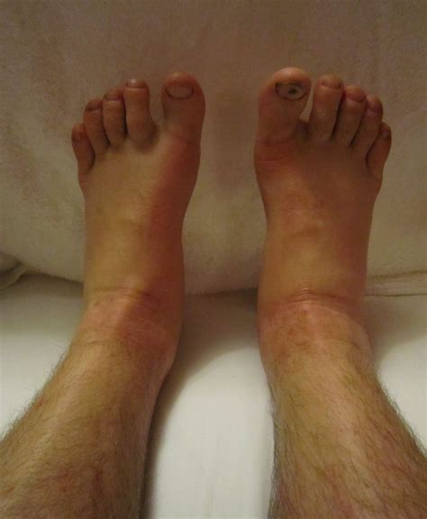 Benign Causes Of Both Ankles Being Swollen And Puffy And Treatment