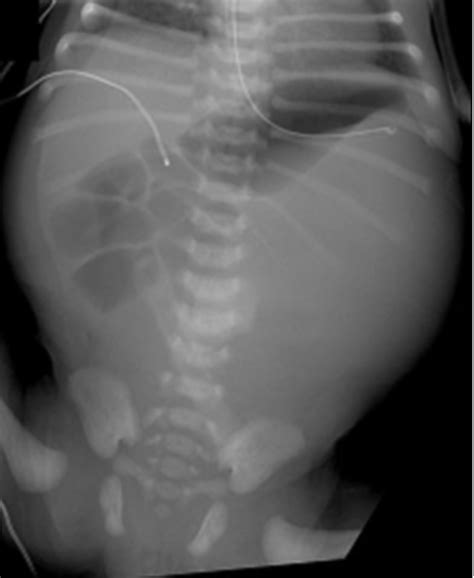 Abdominal Radiograph Demonstrates A Large Soft Tissue Density Within