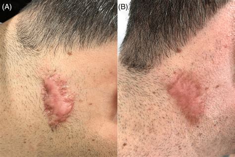 A A Male Patient With A Keloid On His Neck Before Treatment And B