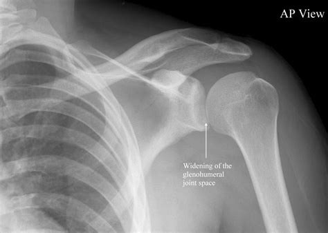 Shoulder Dislocationwhat To Know
