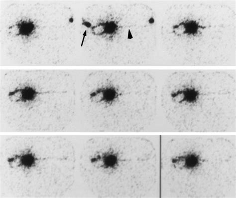 Use Of Sentinel Node Lymphoscintigraphy In Malignant Melanoma