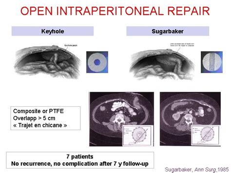 How To Repair Parastomal Hernias Overview Y Renard