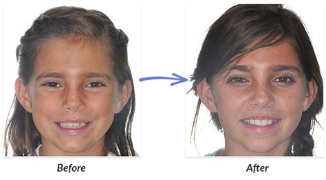 Before And After Braces Photos Delurgio Orthodontics Delurgio Orthodontics