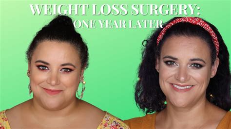 answering your weight loss surgery questions one year after gastric bypass youtube
