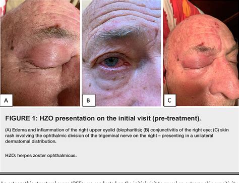 Figure 1 From Osteopathic Manipulative Treatment Of Herpes Zoster