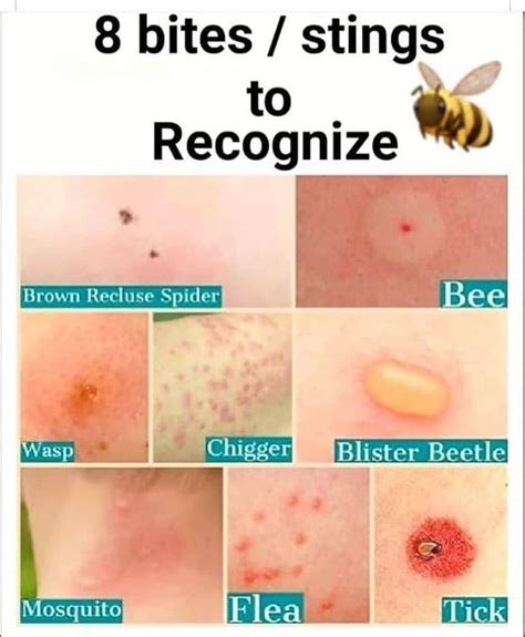 Different Types Of Mosquito Bites And Stings To Recognize With The