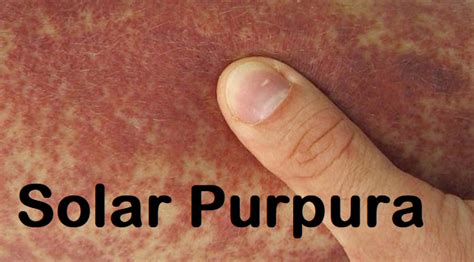 What Is Solar Purpura Symptoms Causes And Diagnosis Health Weighup