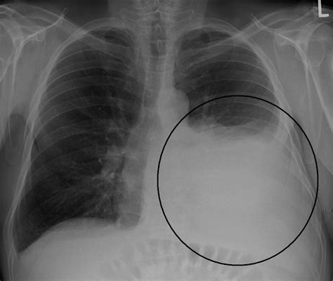 Maybe you would like to learn more about one of these? Malignant Pleural Effusion: Symptoms, Diagnosis ...