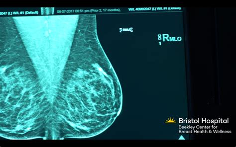 Mammograms Services At Beekley Center Bristol Health Ct