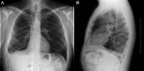 Pleural Effusion Lateral View