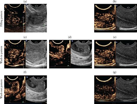 Dynamic Contrast‐enhanced Ultrasound Improves Diagnostic Performance In