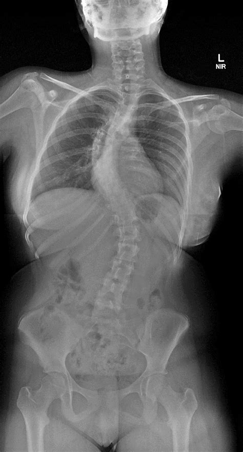 Xray Of The Cervical Spine Showing Thoracic Scoliosis With Cervical My Xxx Hot Girl