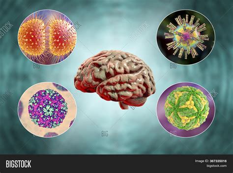 Meningitis Brain Infection