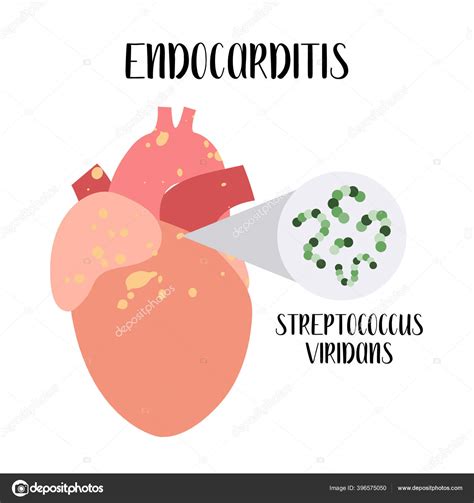 Endocarditis Inflammation Heart Endocardium Streptococcus Viridans