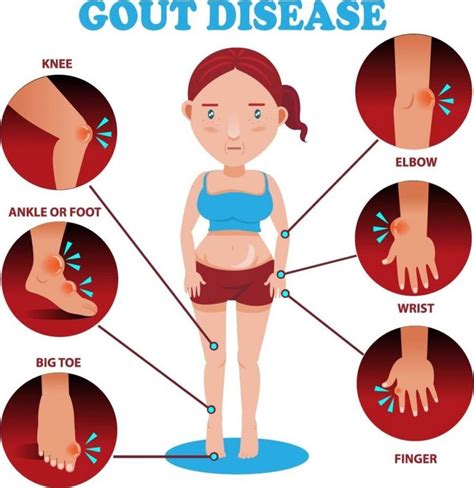 Ghim Trên Gout Causes