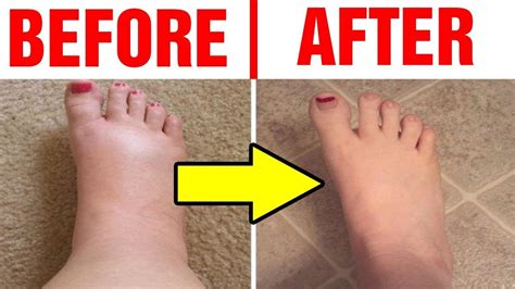 Best Home Remedies For Swollen Feethow To Reduce Swollen Feet