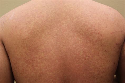 There Is A Fungus Among Us Tinea Versicolor Skin Physicians And Surgeons